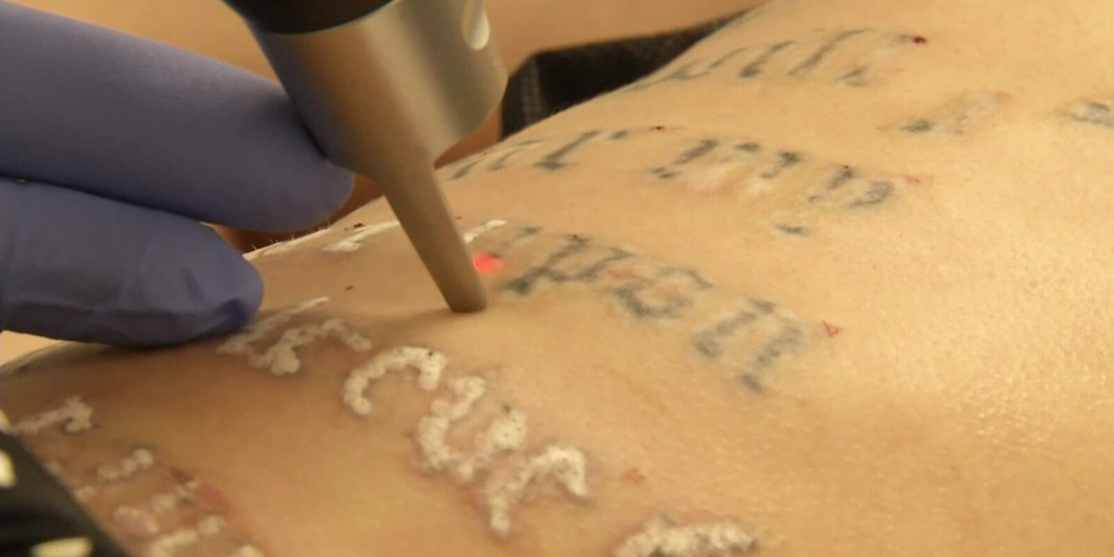 Laser Tattoo Removal Aftercare Products from ZOOTATTOO®