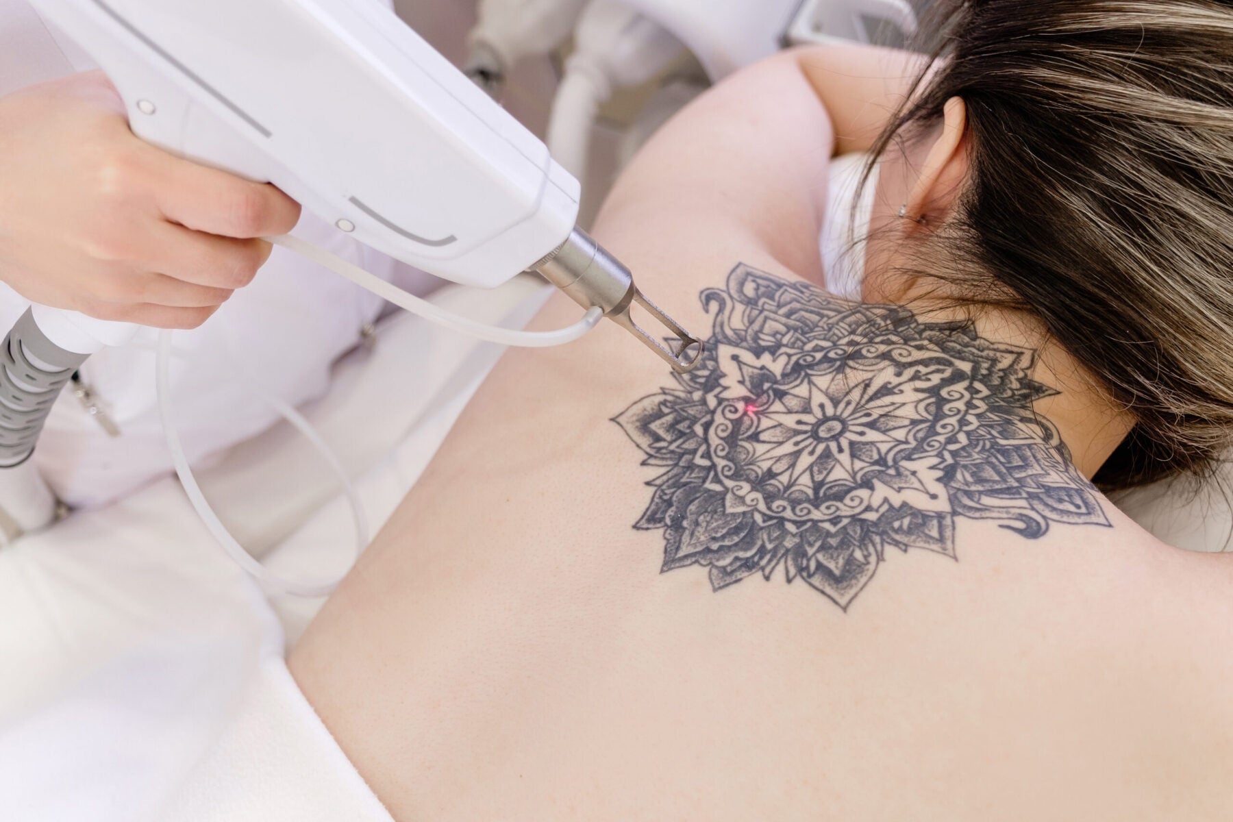 6 Possible Laser Tattoo Removal Side Effects and How to Deal with Them