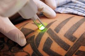 A Guide to Laser Tattoo Removal in Australia